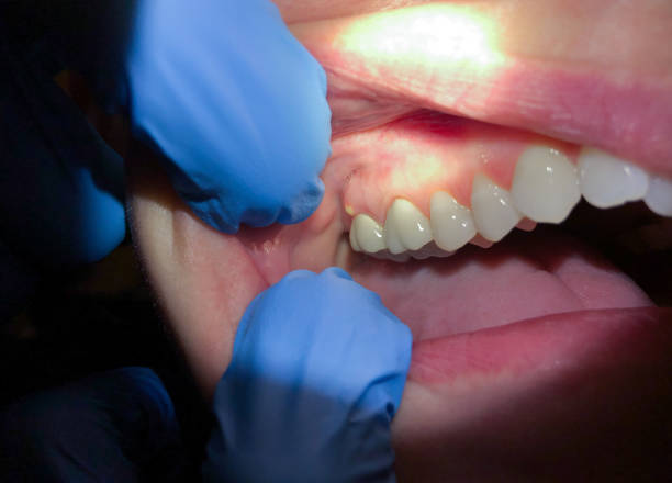 Best Emergency Wisdom Teeth Removal in Crestview, FL